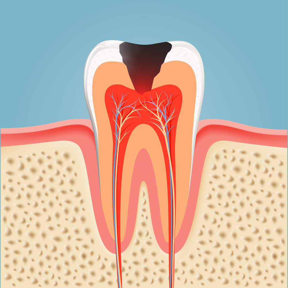 Root-Canal-Procedure-Downtown-Puyallup-WA