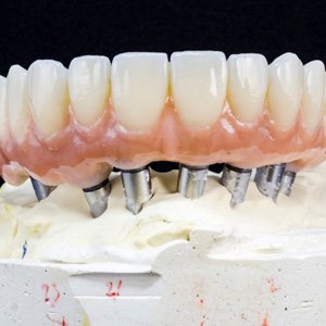 Example of implant dentures in Sumner