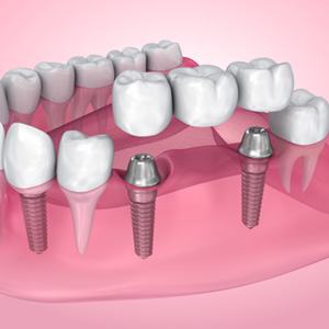 Illustration of dental bridge being attached to dental implants