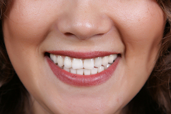 Tacoma teeth whitening dentist in WA near 98404